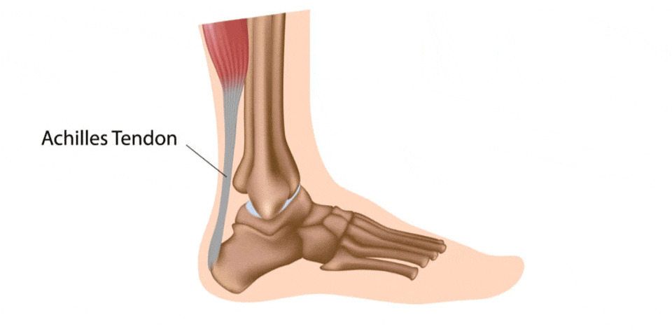 Achilles-tendonitis (1)-0000
